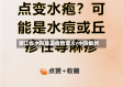 浙江省水痘暴发疫情定义/水痘最新