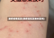 麻疹疫情高发(麻疹现在发病率高吗)