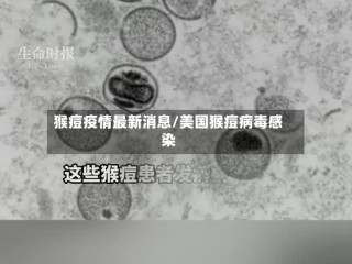 猴痘疫情最新消息/美国猴痘病毒感染