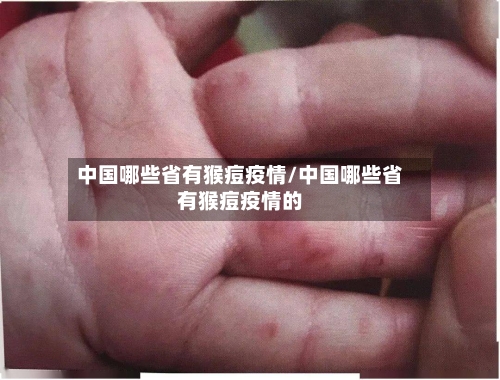 中国哪些省有猴痘疫情/中国哪些省有猴痘疫情的-第1张图片
