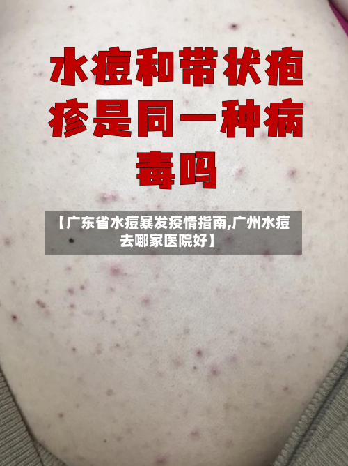 【广东省水痘暴发疫情指南,广州水痘去哪家医院好】-第1张图片