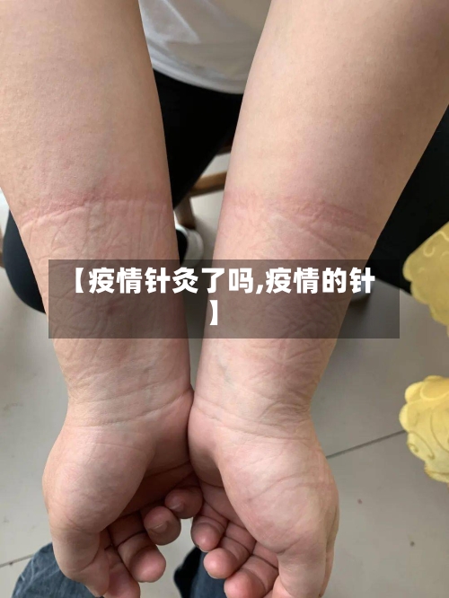 【疫情针灸了吗,疫情的针】-第1张图片