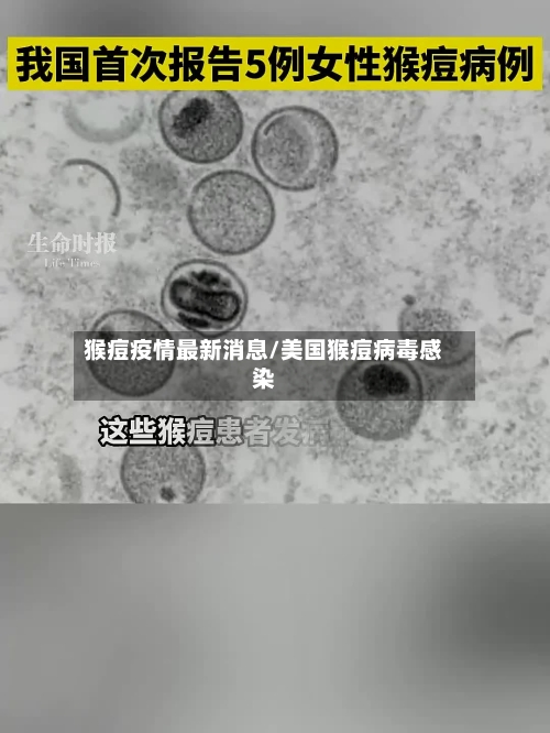 猴痘疫情最新消息/美国猴痘病毒感染-第1张图片