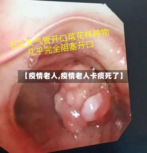 【疫情老人,疫情老人卡痰死了】-第1张图片