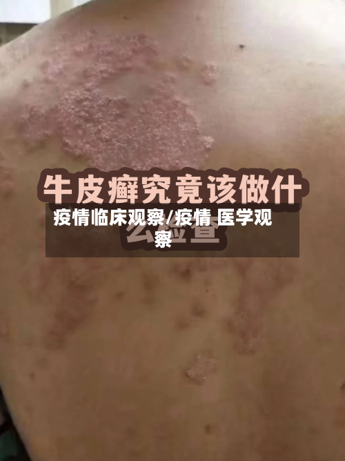 疫情临床观察/疫情 医学观察-第1张图片